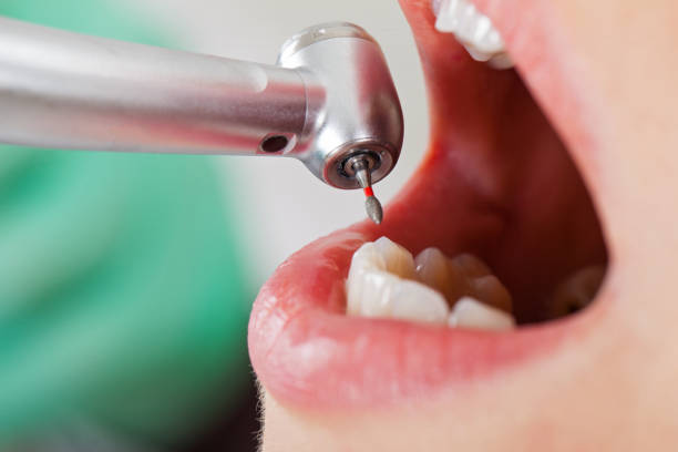 Best Emergency Dentist for Knocked-Out Tooth in Commerce, CA